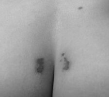 Part 3 of Photo Essay by Sophie Jodoin. It is a black and white image of a bum crack with birth marks or scabs on it